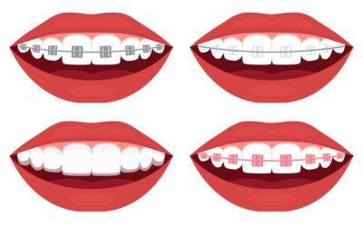 How Braces Can Help A Kid’s Teeth?